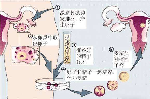 北京供卵试管婴儿龙凤胎费用大约多少